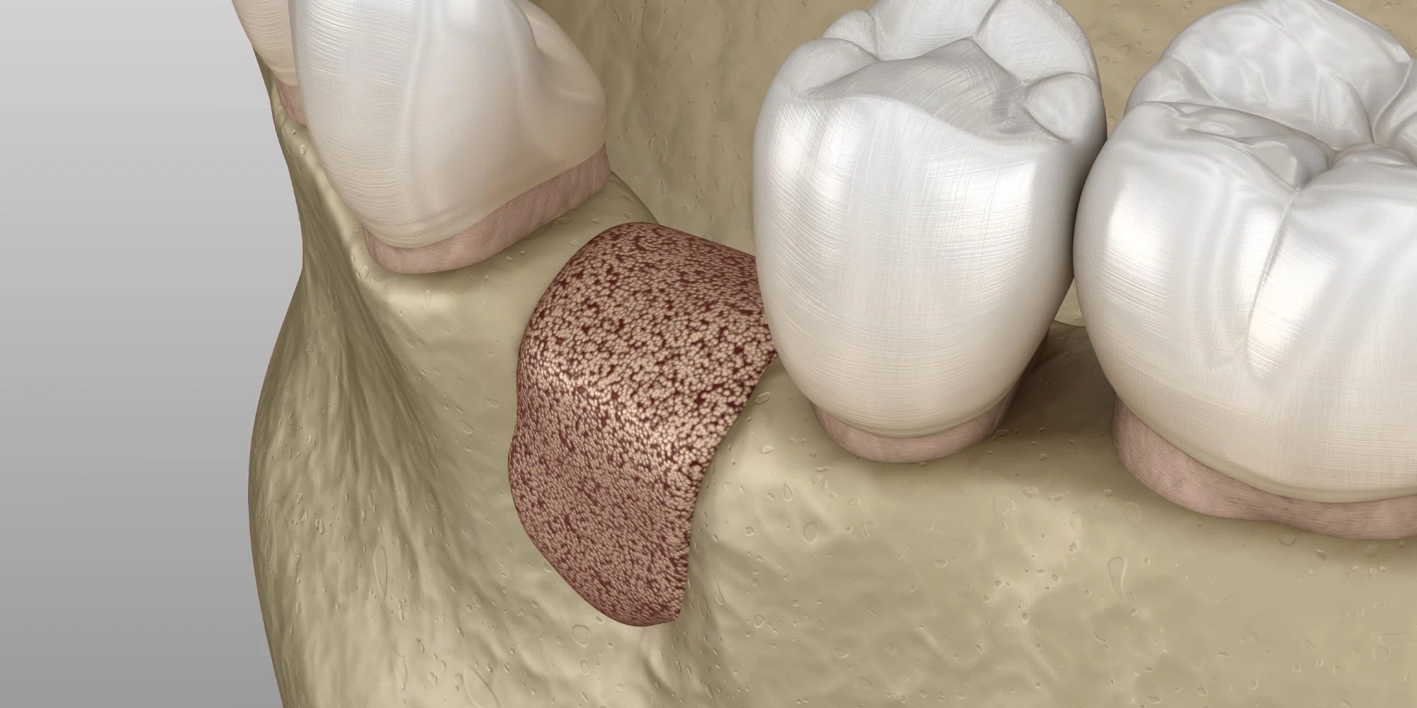 bone-loss