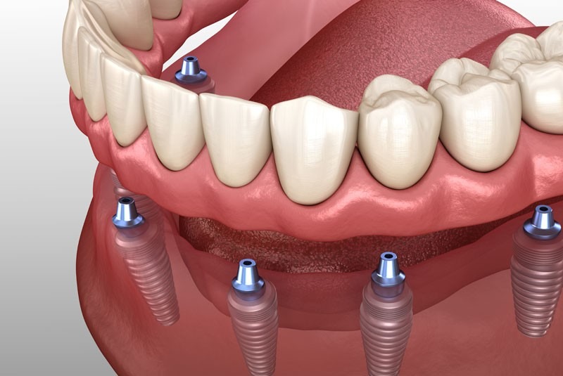 dentures